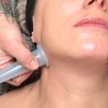 SkinSculpt Facial Cupping